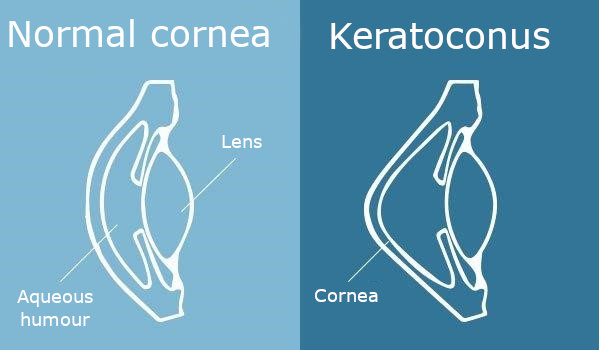 What is keratoconus?